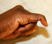 Baseball Finger (also called Mallet Finger) 