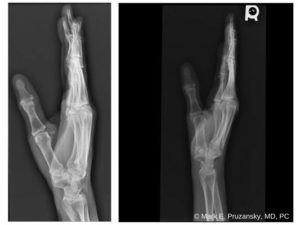 Thumb Ligament Injury 1