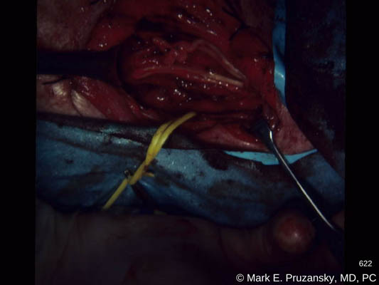 Nerve Surgery 1