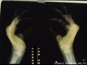 Rheumatoid Arthritis 3