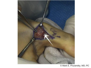 Thumb Ligament Injury 2
