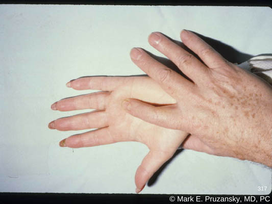 Trigger Finger and Trigger Thumb (Tenosynovitis) 1